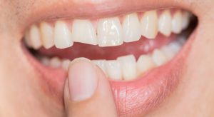 woman showing her chipped tooth